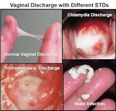 STI & Discharge Treatements